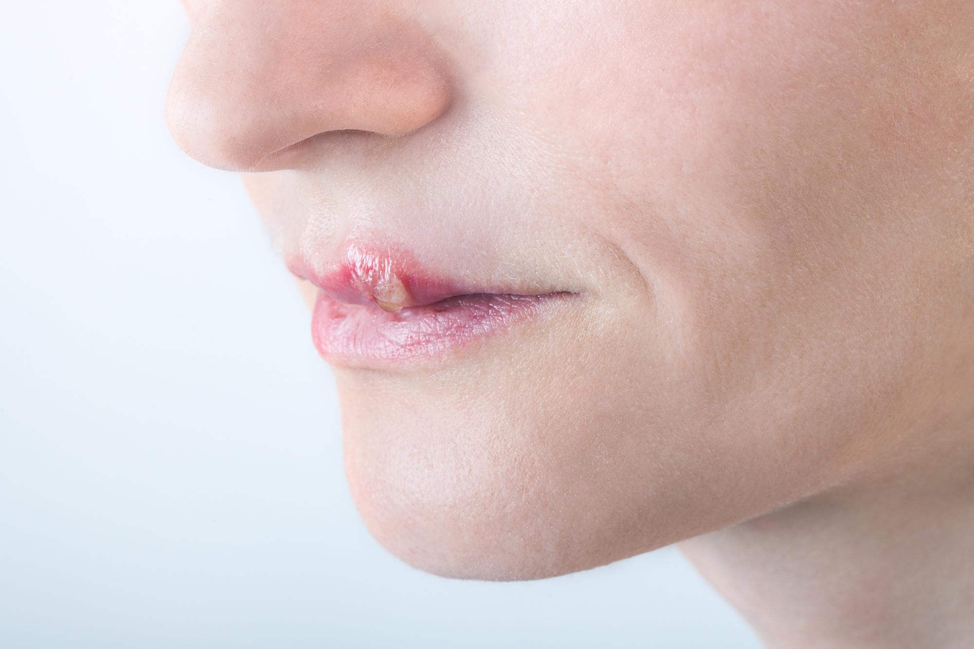 口唇ヘルペスはうつる 感染経路 受診するべき病院 予防法をチェック