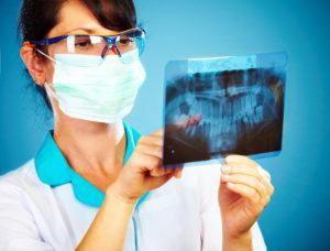 埋伏歯の抜歯が必要なのはどんな時？費用と治療後のケアまとめ