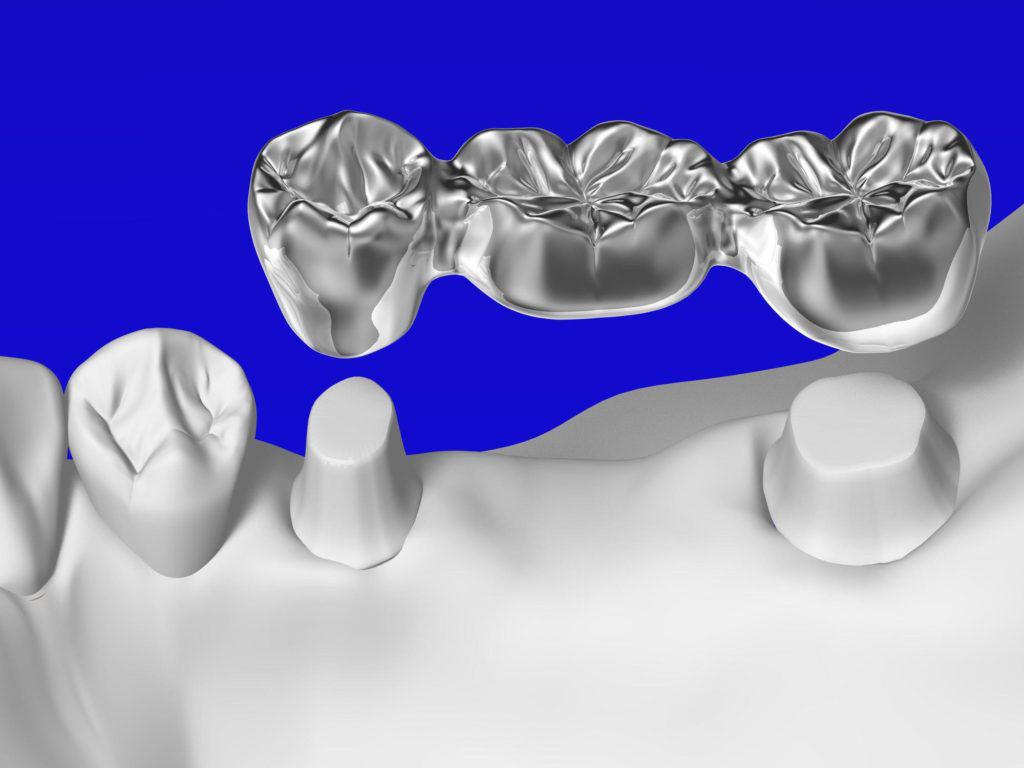 歯のブリッジのメリット デメリットとは 歯が抜けた時の治療法検討の参考に