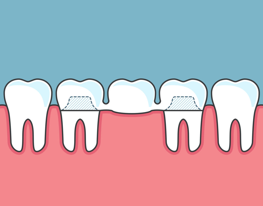 歯のブリッジのメリット デメリットとは 歯が抜けた時の治療法検討の参考に